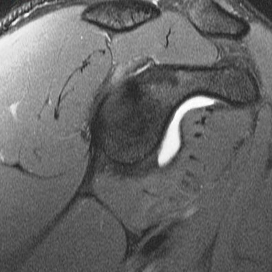 Figure 4 for case Posterior Peel Back Lesion of Internal Impingement